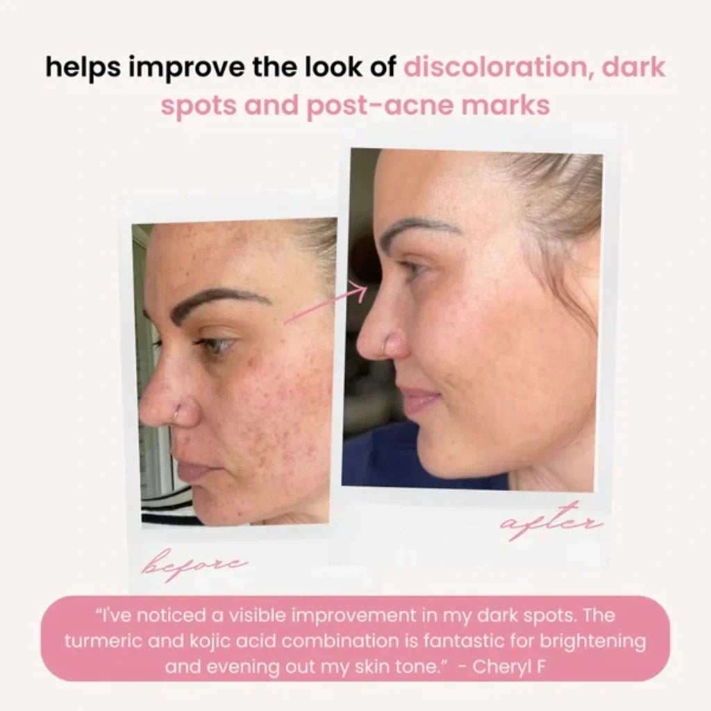 Turmeric Kojic Acid Pads(PACK OF 20 PADS😍)