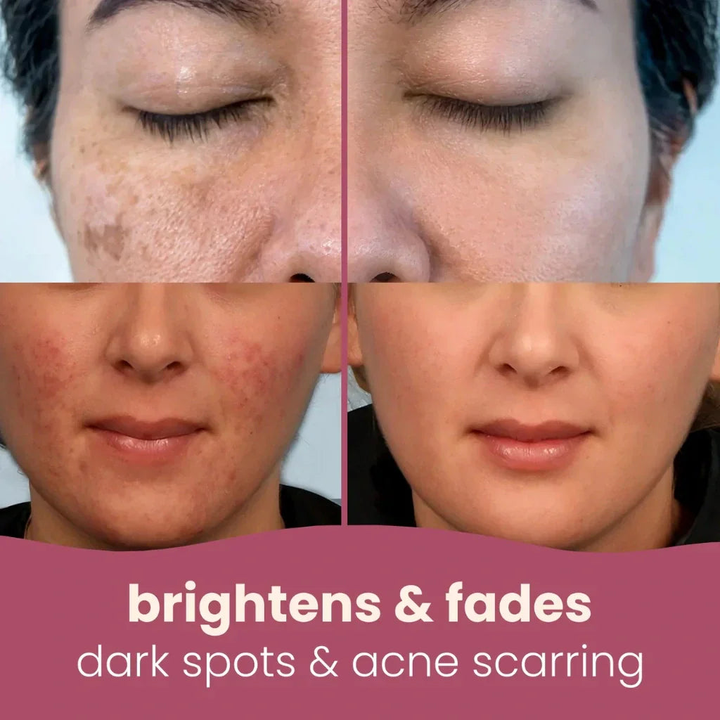 Turmeric Kojic Acid Pads(PACK OF 20 PADS😍)